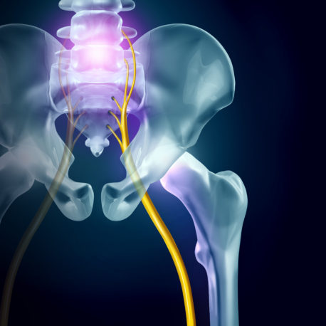 Sciatica pain symptoms and diagnosis medical concept as a disease causing physical problems with 3D illustration elements